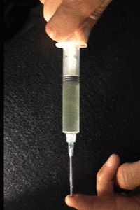 Simulation of ultrasonic cavitation in a syringe